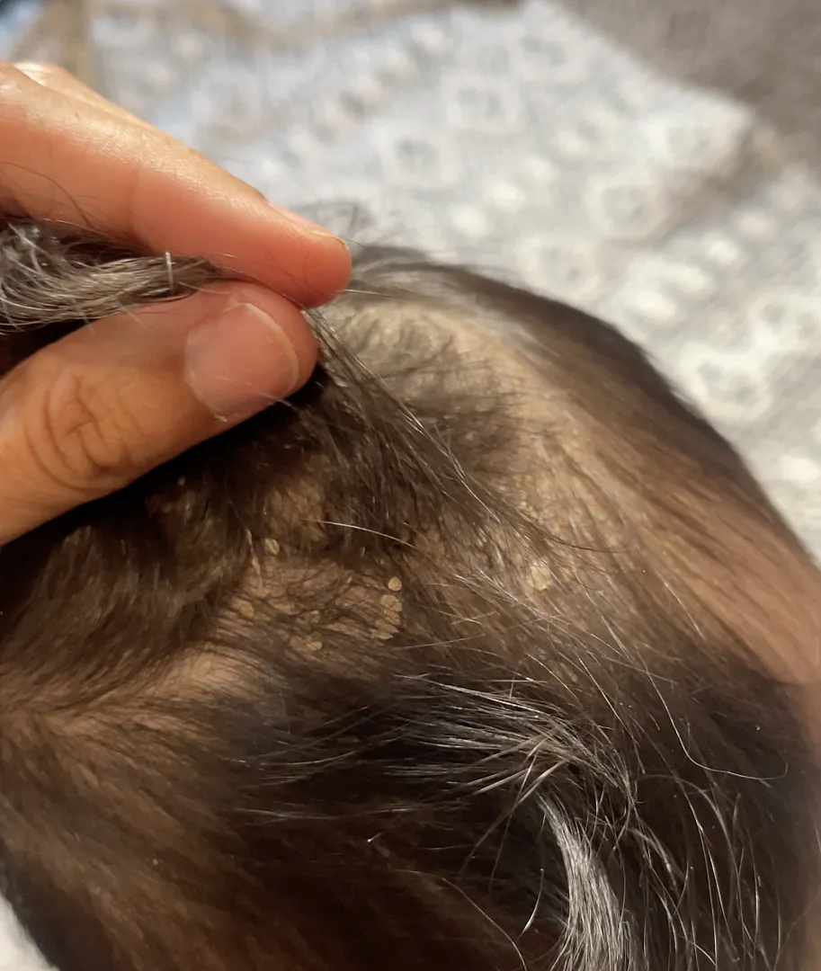 Earth Mama Cradle Cap Cream kräm mot mjölkskorv